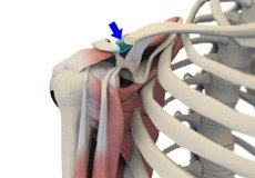 Distal Clavicle Excision