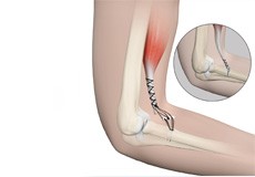 Elbow Tendon and Ligament Repair