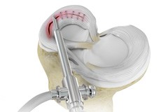 Failed Meniscus Repair