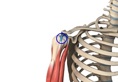 Long Head Biceps Tendon Rupture