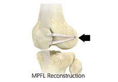 Medial Patellofemoral Ligament Reconstruction