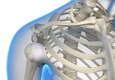 Multidirectional Instability of the Shoulder