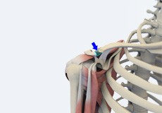 Mumford Distal Clavicle Excision