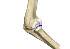 Osteochondritis Dissecans of the Knee