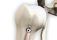 proximal biceps tenodesis tendon