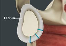 Shoulder Labrum Reconstruction